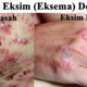 Illustration for article titled Salep Eksim Basah Yang Manjur Dari Denatureem/em